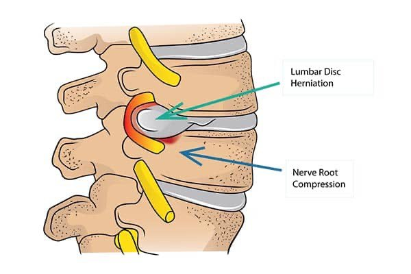 کمردرد؛ عارضهای جدی که نیاز به تشخیص و درمان فوری دارد